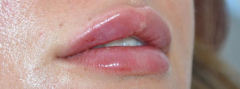 Fillers Before & After Gallery - Patient 191674649 - Image 2
