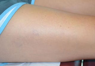 Laser Before & After Gallery - Patient 191674650 - Image 4