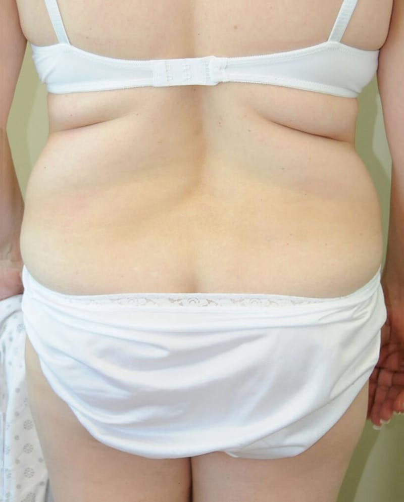 Tummy Tuck Before & After Gallery - Patient 191674653 - Image 5