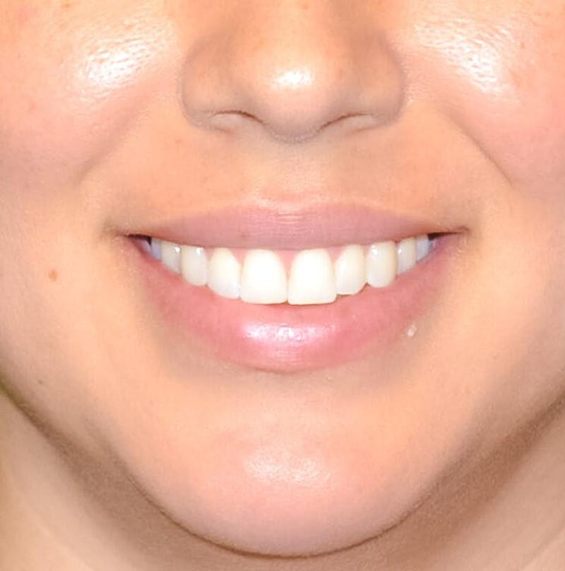 Fillers Before & After Gallery - Patient 191674654 - Image 1