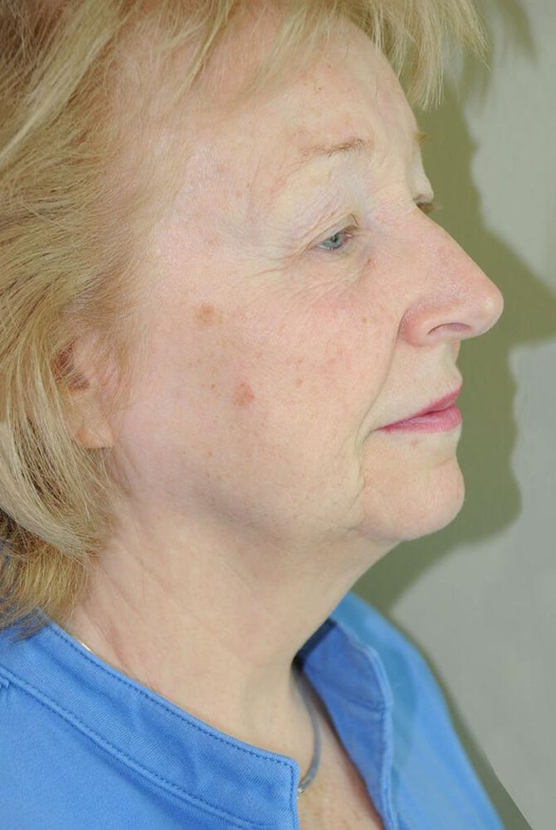 Face and Neck Lifts Before & After Gallery - Patient 191674656 - Image 5
