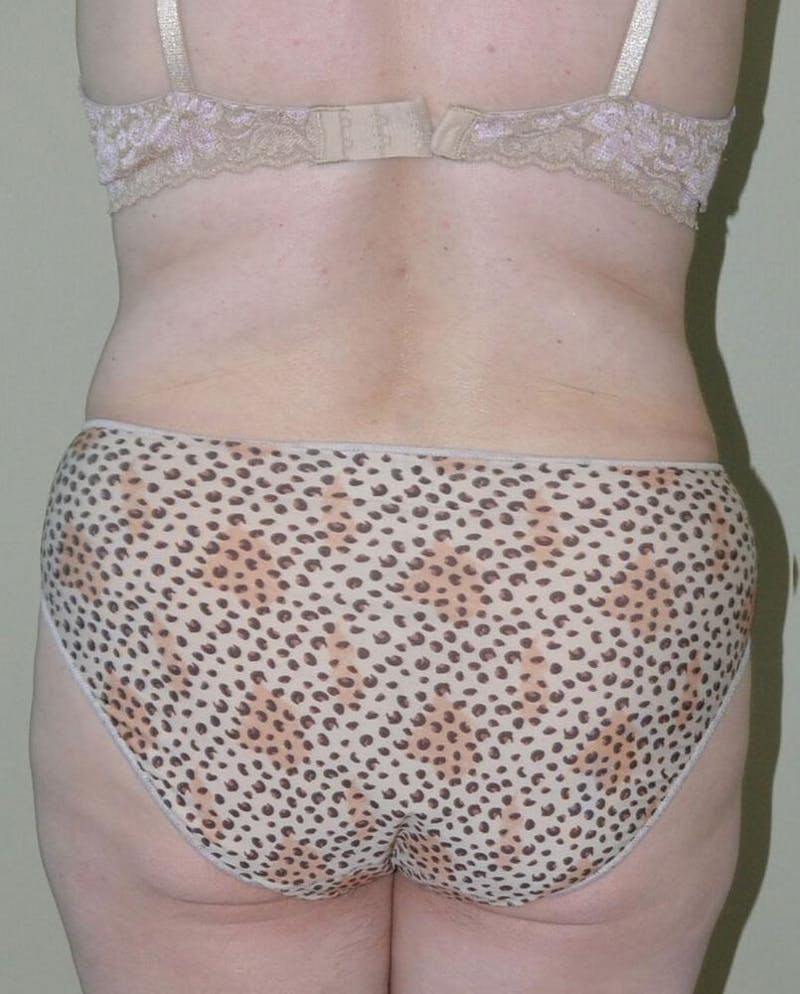 Tummy Tuck Before & After Gallery - Patient 191674653 - Image 6