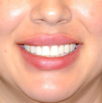 Fillers Before & After Gallery - Patient 191674654 - Image 2