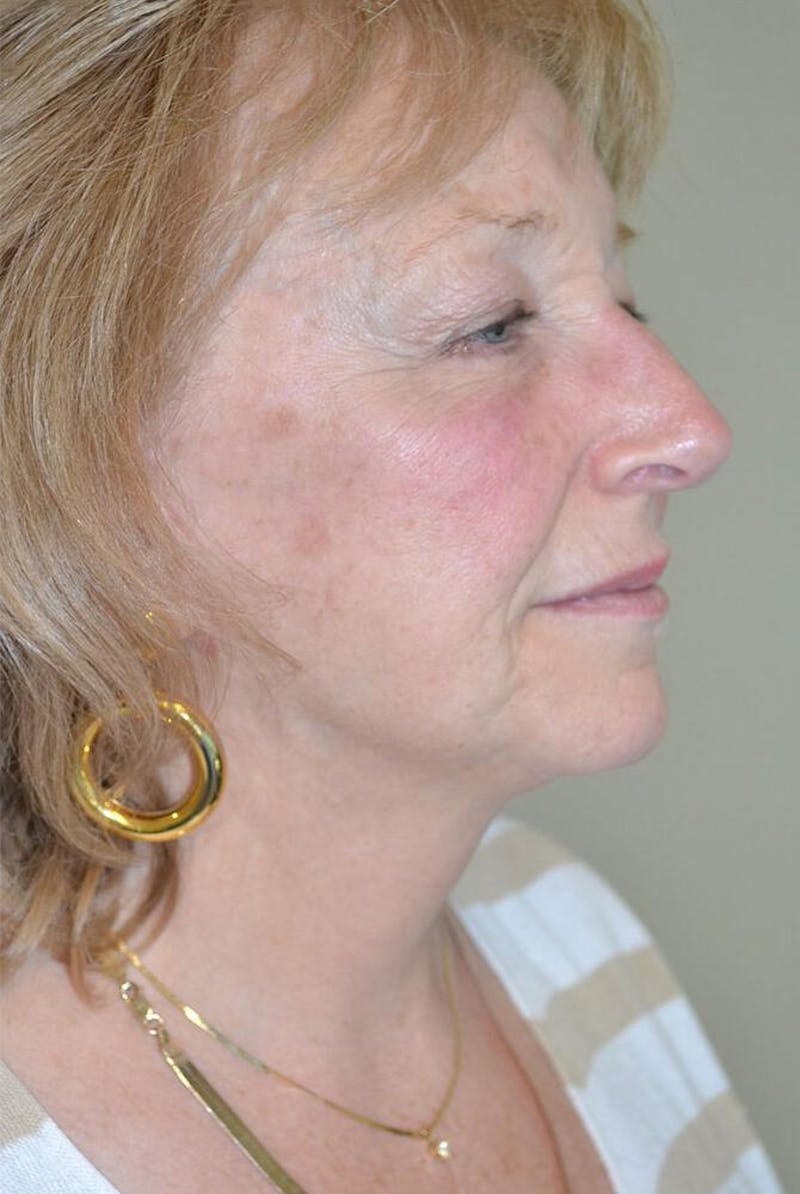 Face and Neck Lifts Before & After Gallery - Patient 191674656 - Image 6