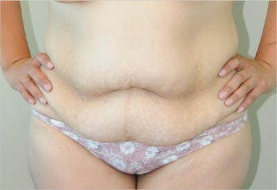 Tummy Tuck Before & After Gallery - Patient 191674662 - Image 1