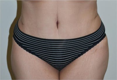Tummy Tuck Before & After Gallery - Patient 191674662 - Image 2