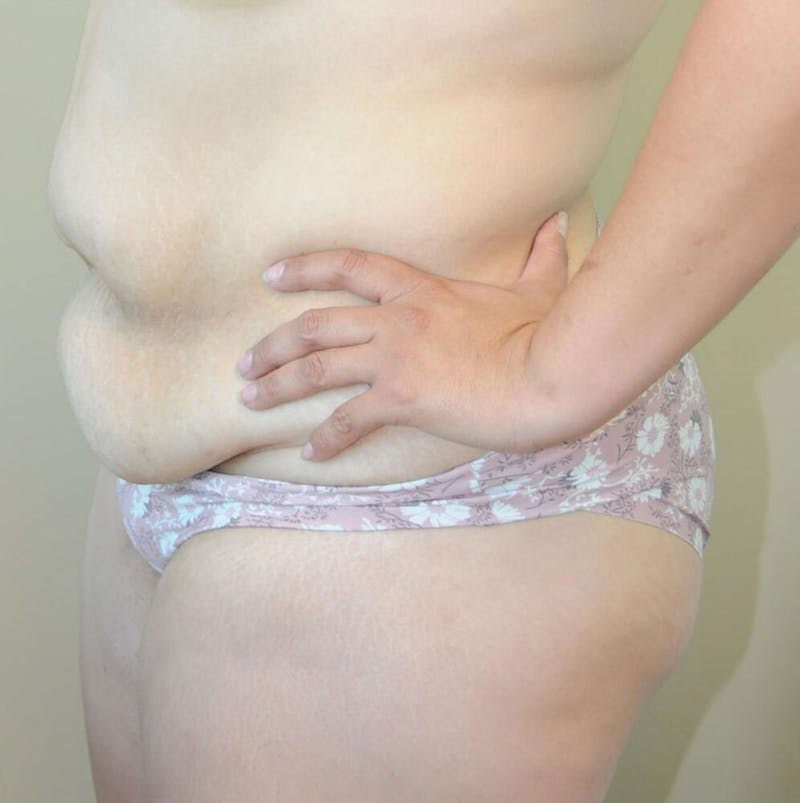 Tummy Tuck Before & After Gallery - Patient 191674662 - Image 3