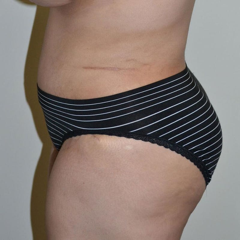 Tummy Tuck Before & After Gallery - Patient 191674662 - Image 4