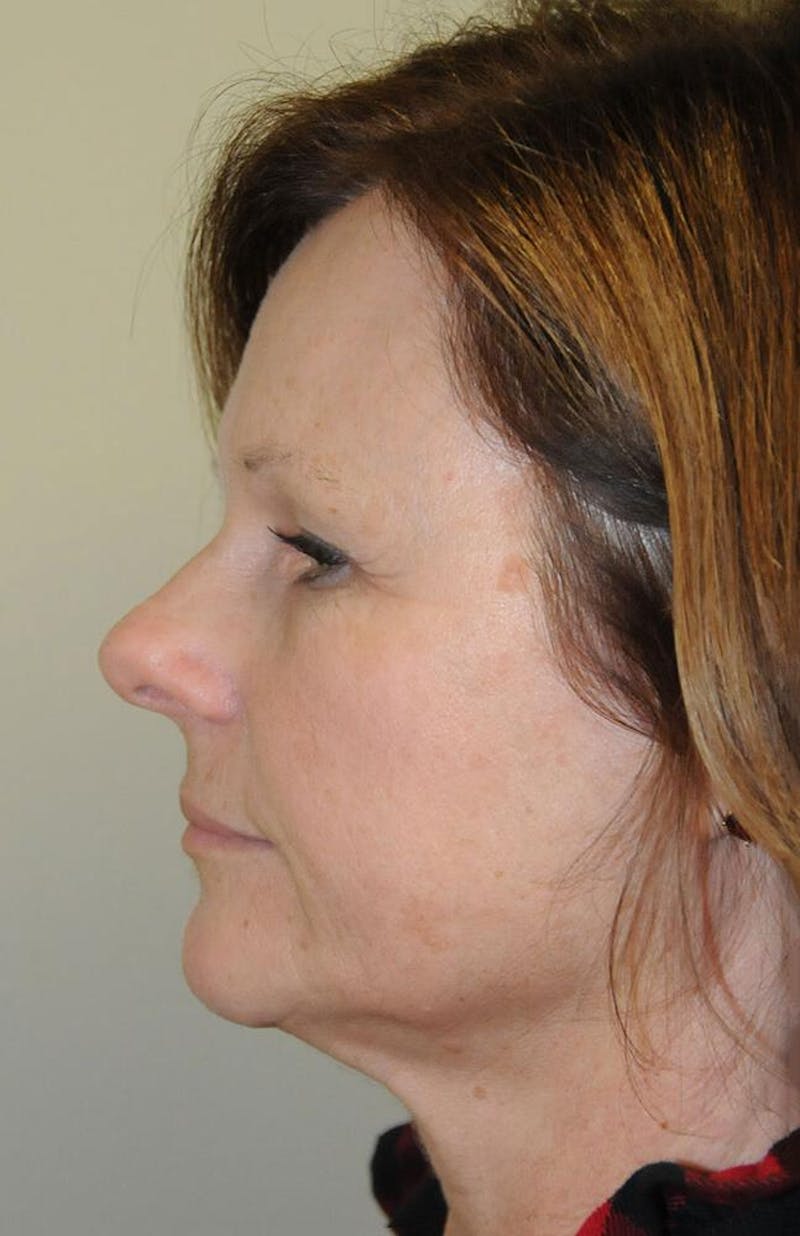 Face and Neck Lifts Before & After Gallery - Patient 191674663 - Image 3