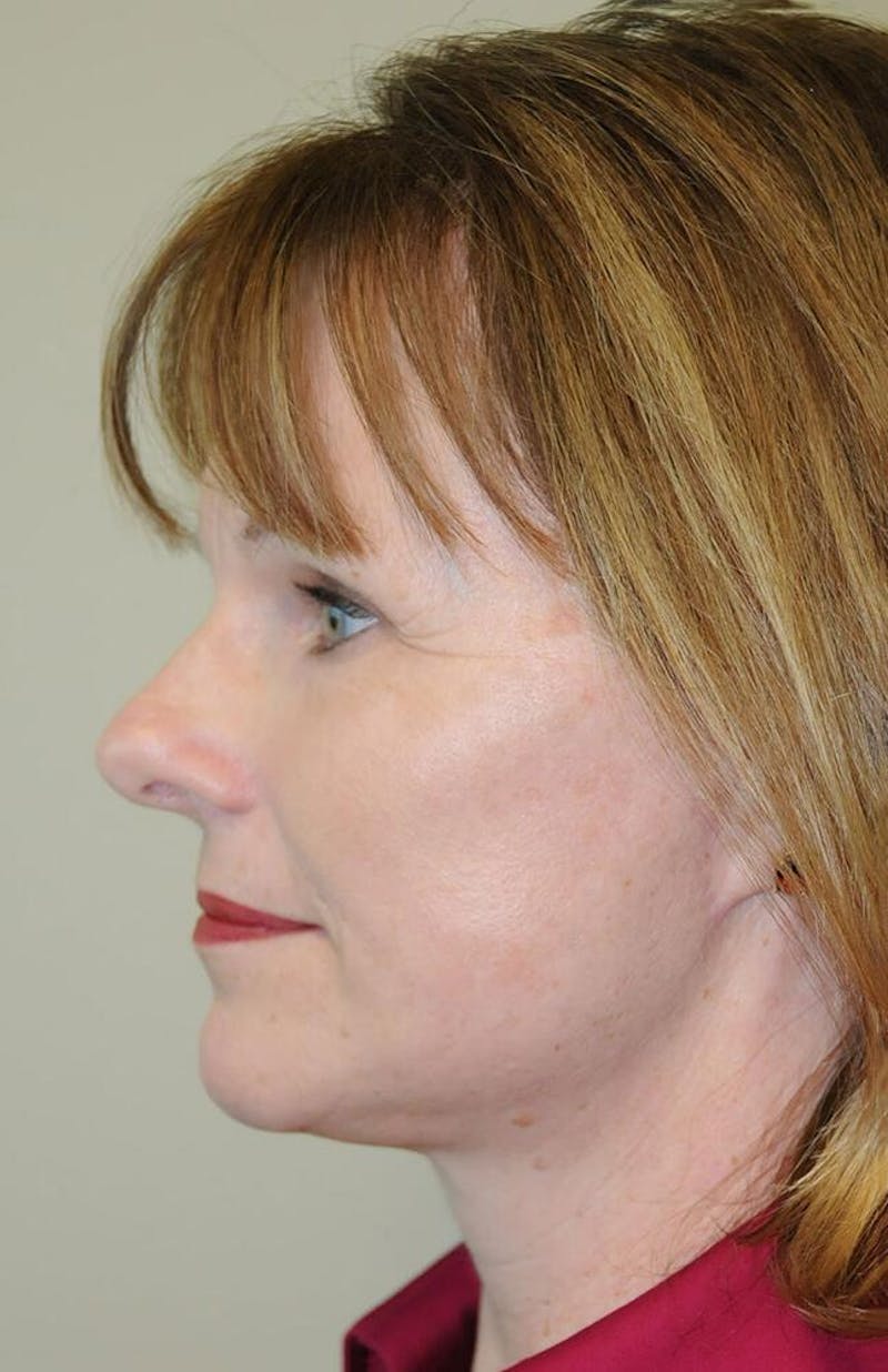 Face and Neck Lifts Before & After Gallery - Patient 191674663 - Image 4