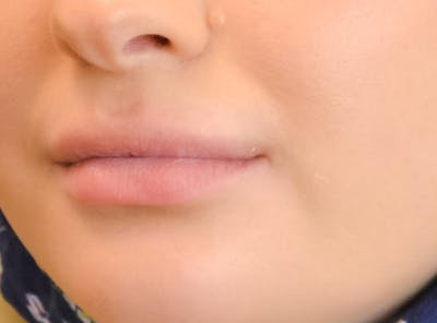 Fillers Before & After Gallery - Patient 191674664 - Image 1