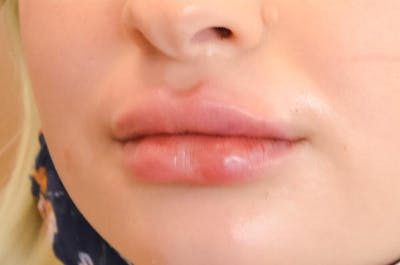Fillers Before & After Gallery - Patient 191674664 - Image 2