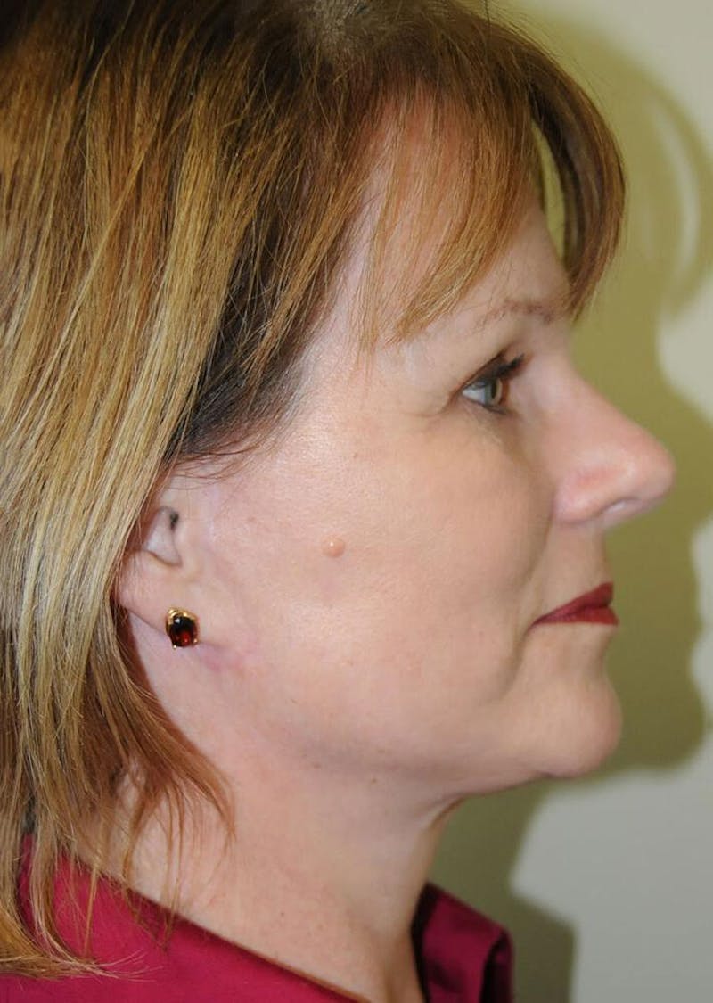 Face and Neck Lifts Before & After Gallery - Patient 191674663 - Image 6