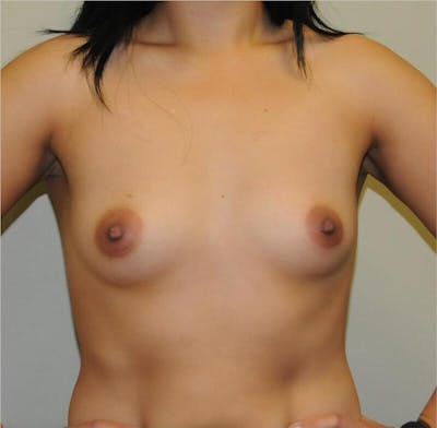 Breast Augmentation Before & After Gallery - Patient 191674666 - Image 1