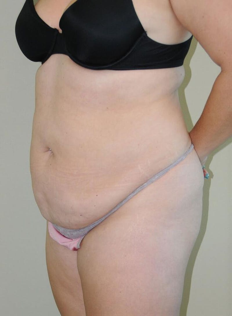 Tummy Tuck Before & After Gallery - Patient 191674709 - Image 3