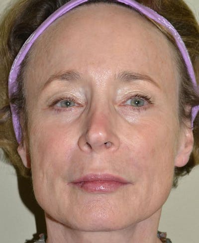 Fillers Before & After Gallery - Patient 191674707 - Image 2