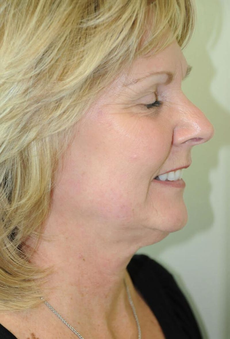 Face and Neck Lifts Before & After Gallery - Patient 191674683 - Image 3