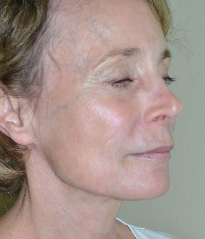 Fillers Before & After Gallery - Patient 191674707 - Image 3