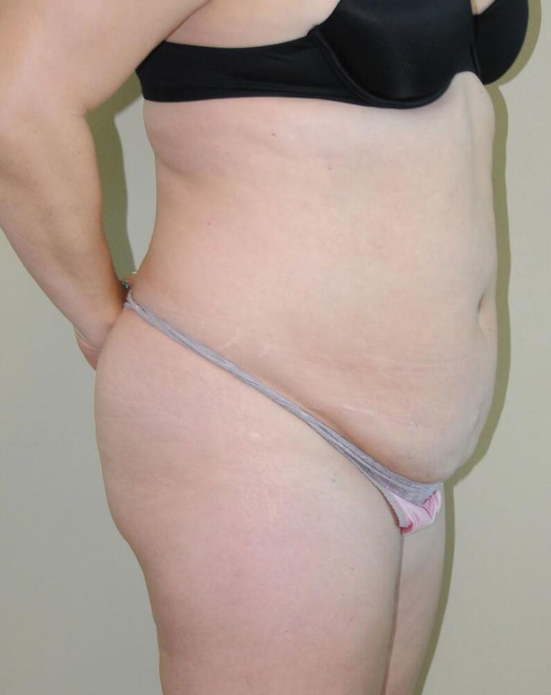 Tummy Tuck Before & After Gallery - Patient 191674709 - Image 5