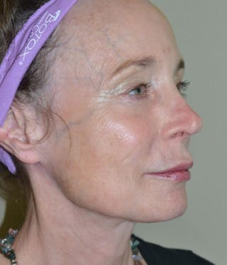 Fillers Before & After Gallery - Patient 191674707 - Image 4