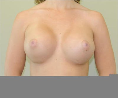 Breast Augmentation Before & After Gallery - Patient 191674712 - Image 2