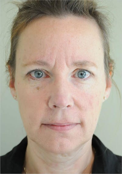 Face and Neck Lifts Before & After Gallery - Patient 191674713 - Image 1