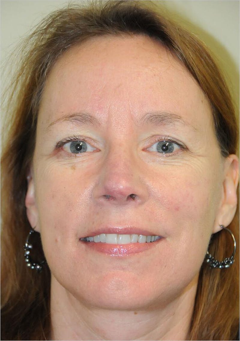 Face and Neck Lifts Before & After Gallery - Patient 191674713 - Image 2