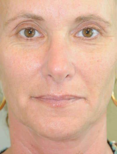 Fillers Before & After Gallery - Patient 191674711 - Image 1