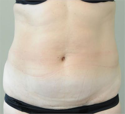 Tummy Tuck Before & After Gallery - Patient 191674716 - Image 1