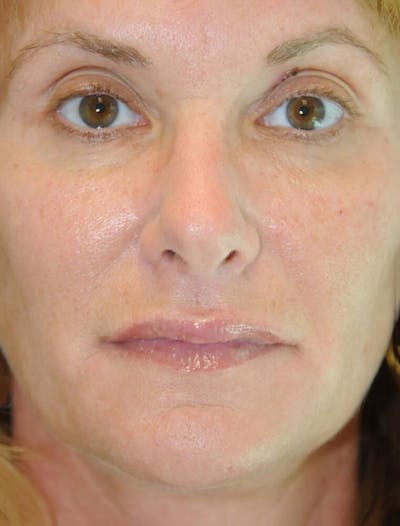 Fillers Before & After Gallery - Patient 191674711 - Image 2