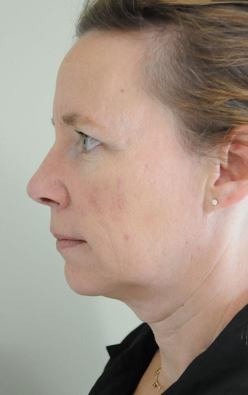 Face and Neck Lifts Before & After Gallery - Patient 191674713 - Image 3