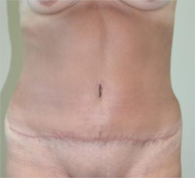 Tummy Tuck Before & After Gallery - Patient 191674716 - Image 2