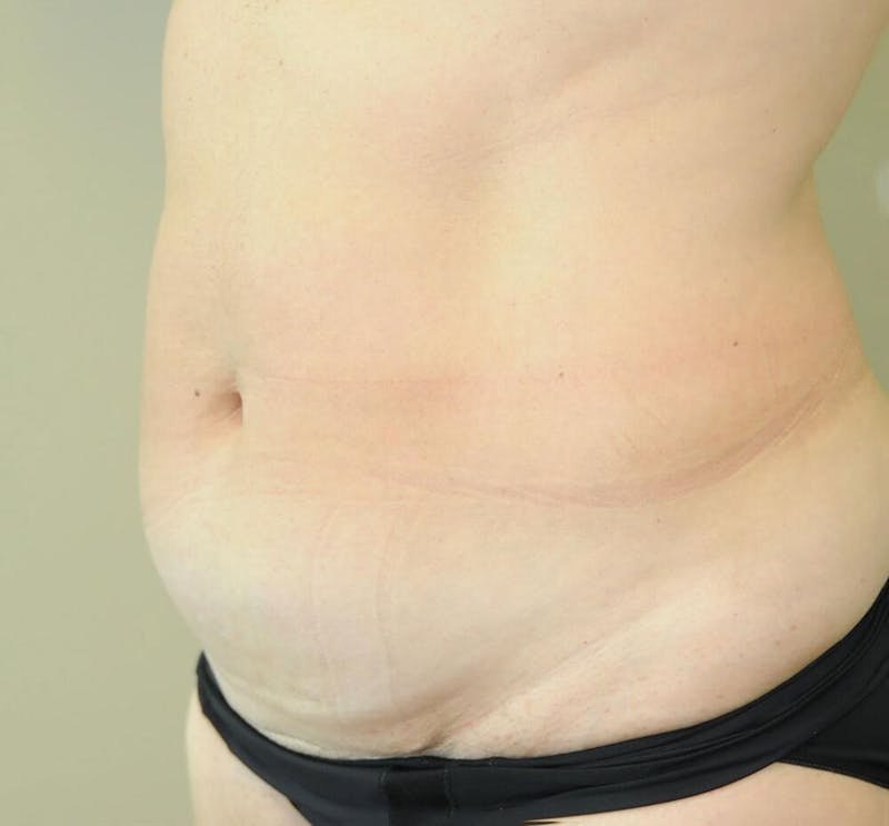 Tummy Tuck Before & After Gallery - Patient 191674716 - Image 3