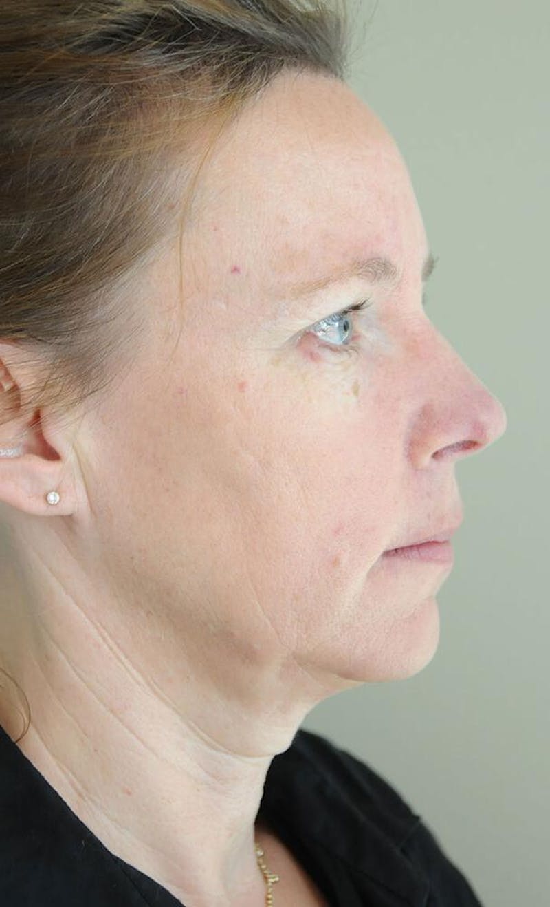Face and Neck Lifts Before & After Gallery - Patient 191674713 - Image 5