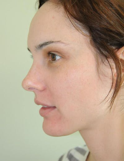 Fillers Before & After Gallery - Patient 191674717 - Image 2