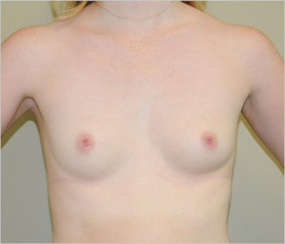 Breast Augmentation Before & After Gallery - Patient 191674718 - Image 1