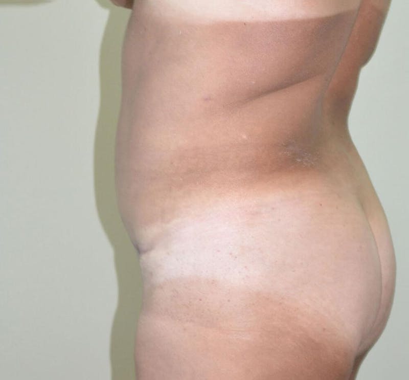 Tummy Tuck Before & After Gallery - Patient 191674716 - Image 4
