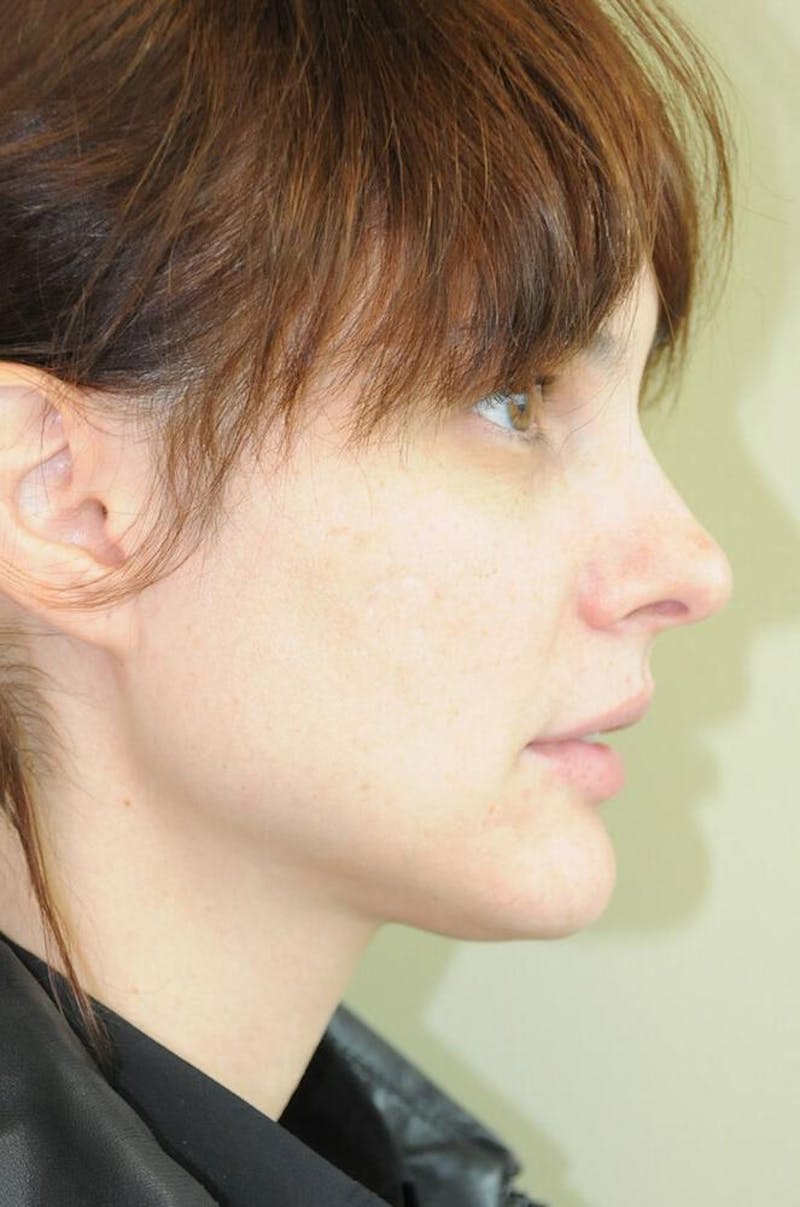 Fillers Before & After Gallery - Patient 191674717 - Image 3