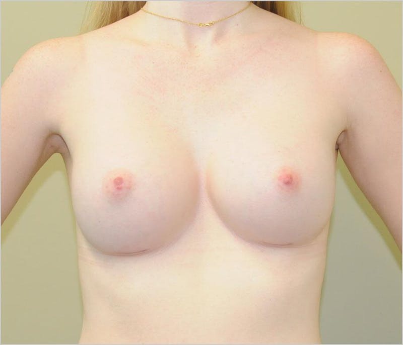 Breast Augmentation Before & After Gallery - Patient 191674718 - Image 2