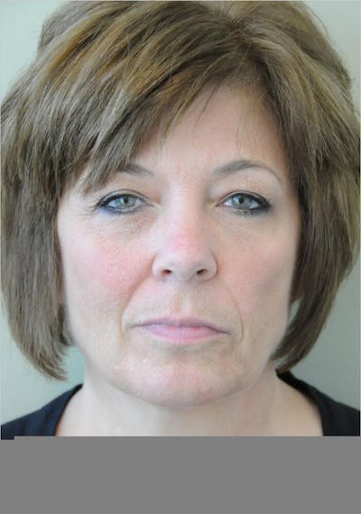 Face and Neck Lifts Before & After Gallery - Patient 191674719 - Image 1