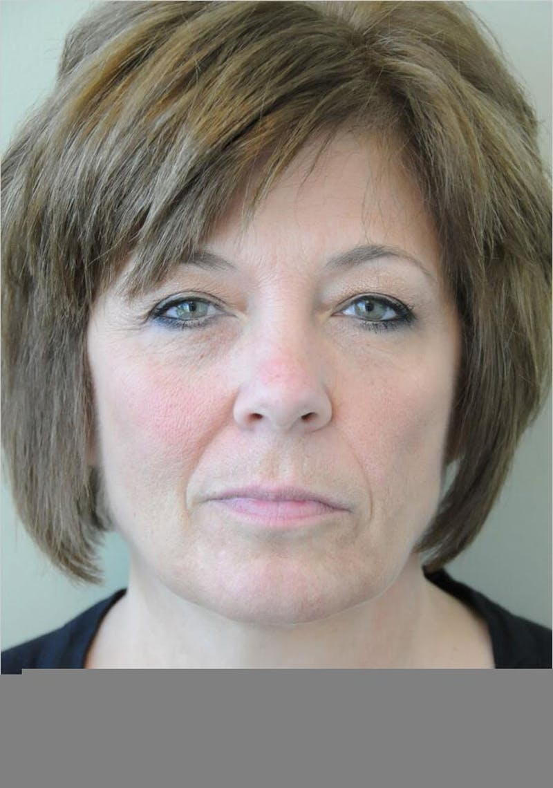 Face and Neck Lifts Before & After Gallery - Patient 191674719 - Image 1