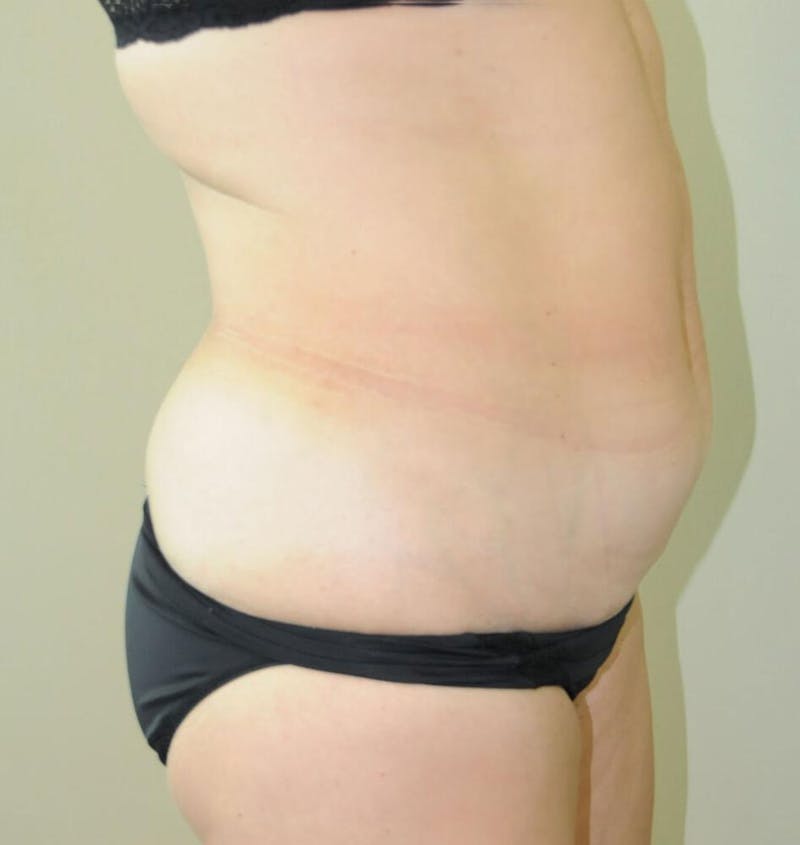 Tummy Tuck Before & After Gallery - Patient 191674716 - Image 5