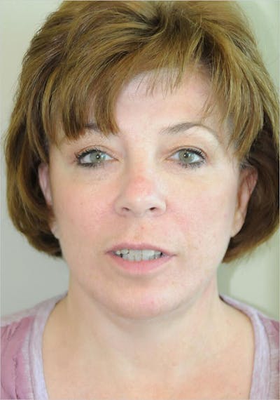 Face and Neck Lifts Before & After Gallery - Patient 191674719 - Image 2