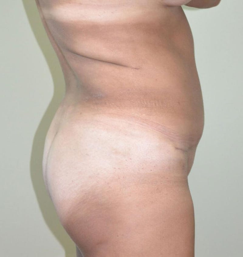 Tummy Tuck Before & After Gallery - Patient 191674716 - Image 6