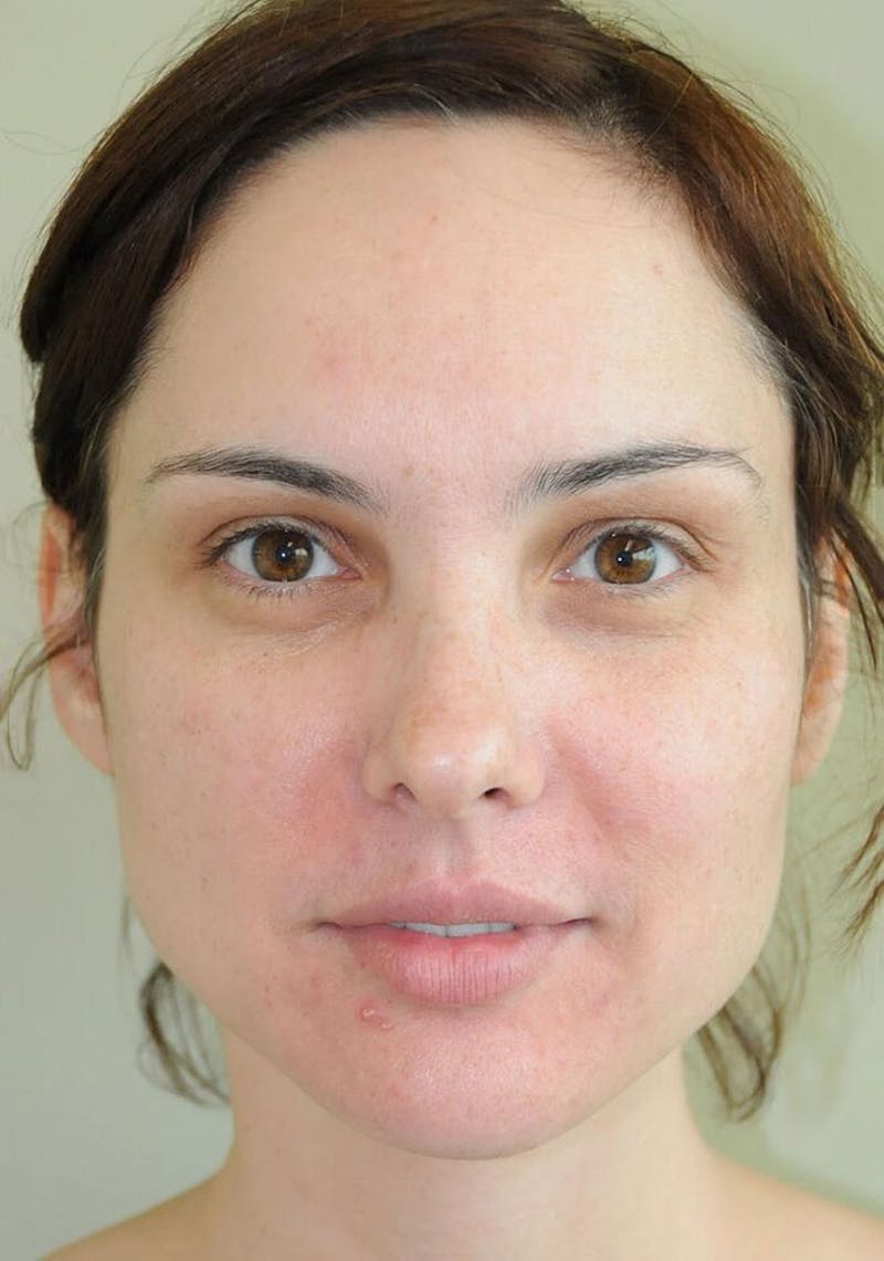 Fillers Before & After Gallery - Patient 191674717 - Image 6