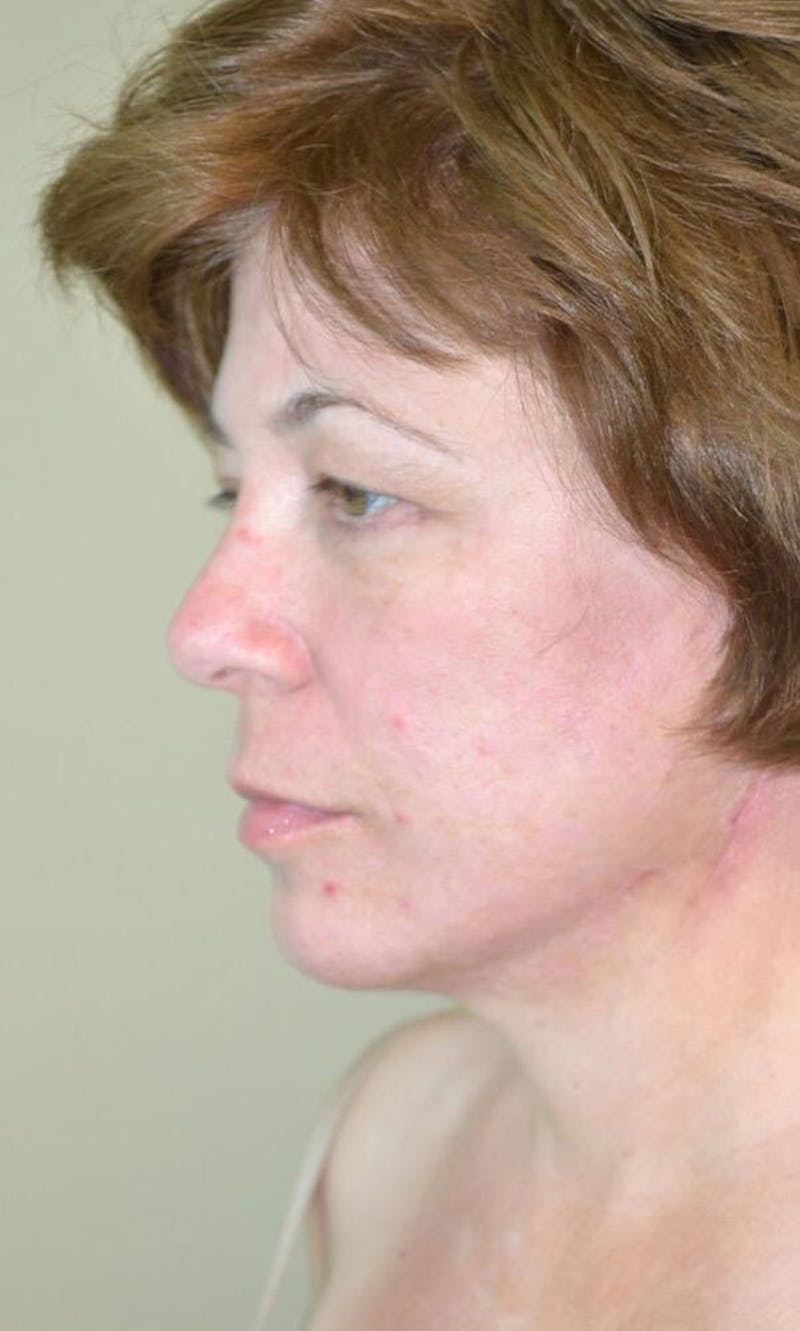 Face and Neck Lifts Before & After Gallery - Patient 191674719 - Image 4