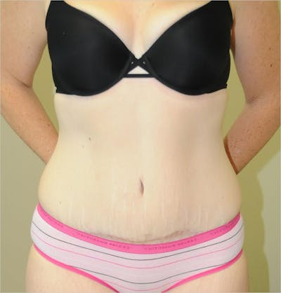 Tummy Tuck Before & After Gallery - Patient 191674720 - Image 2
