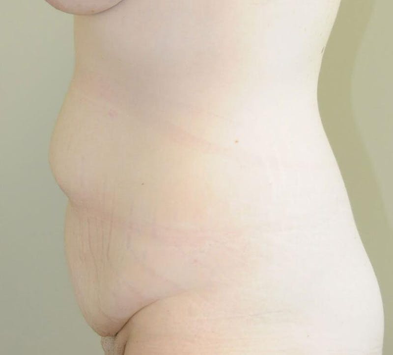 Tummy Tuck Before & After Gallery - Patient 191674720 - Image 3