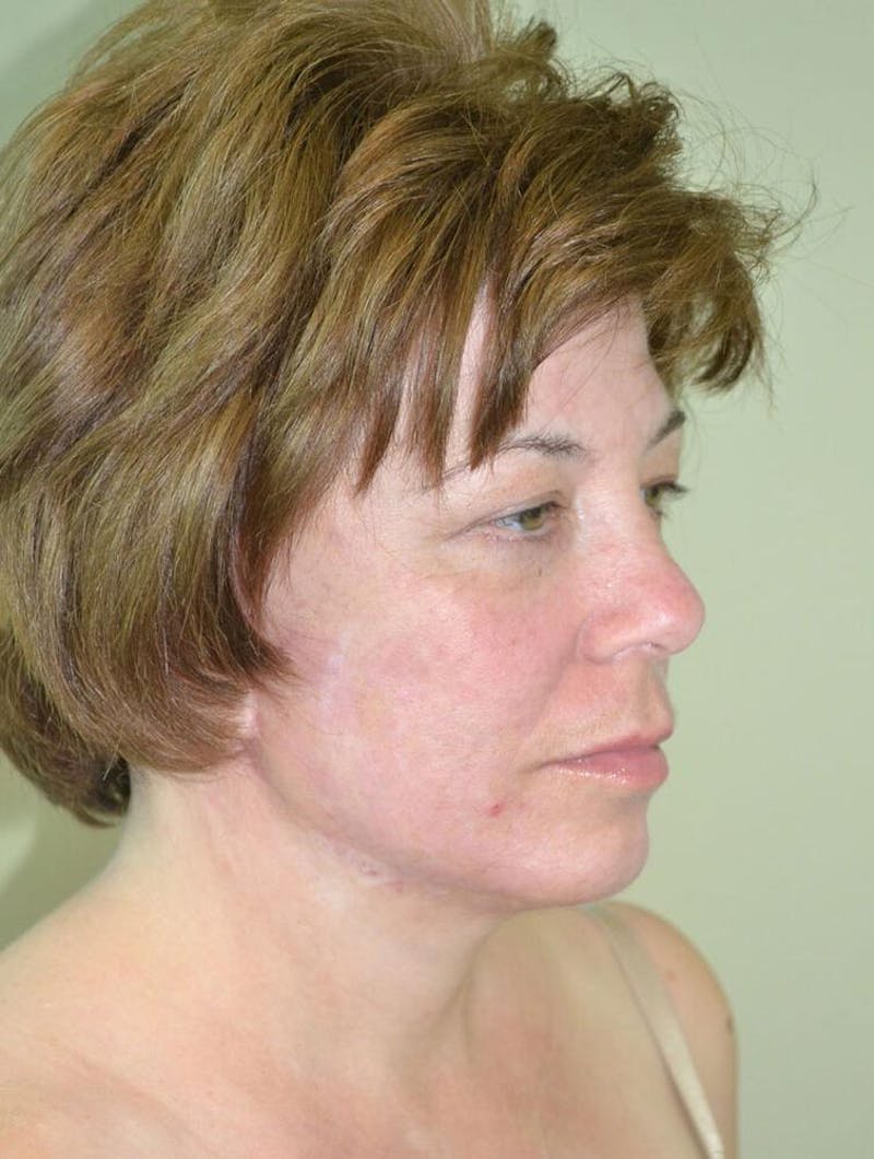 Face and Neck Lifts Before & After Gallery - Patient 191674719 - Image 6