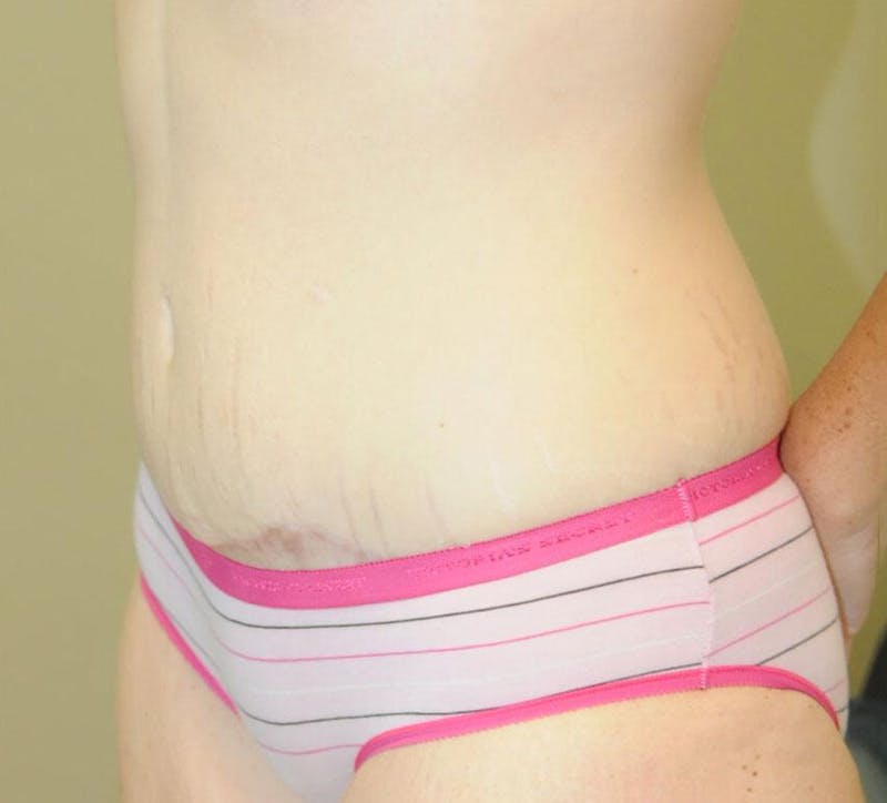 Tummy Tuck Before & After Gallery - Patient 191674720 - Image 4